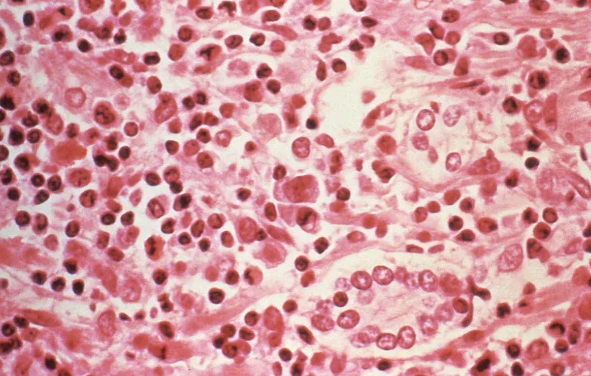 hantavirus-yozI_large